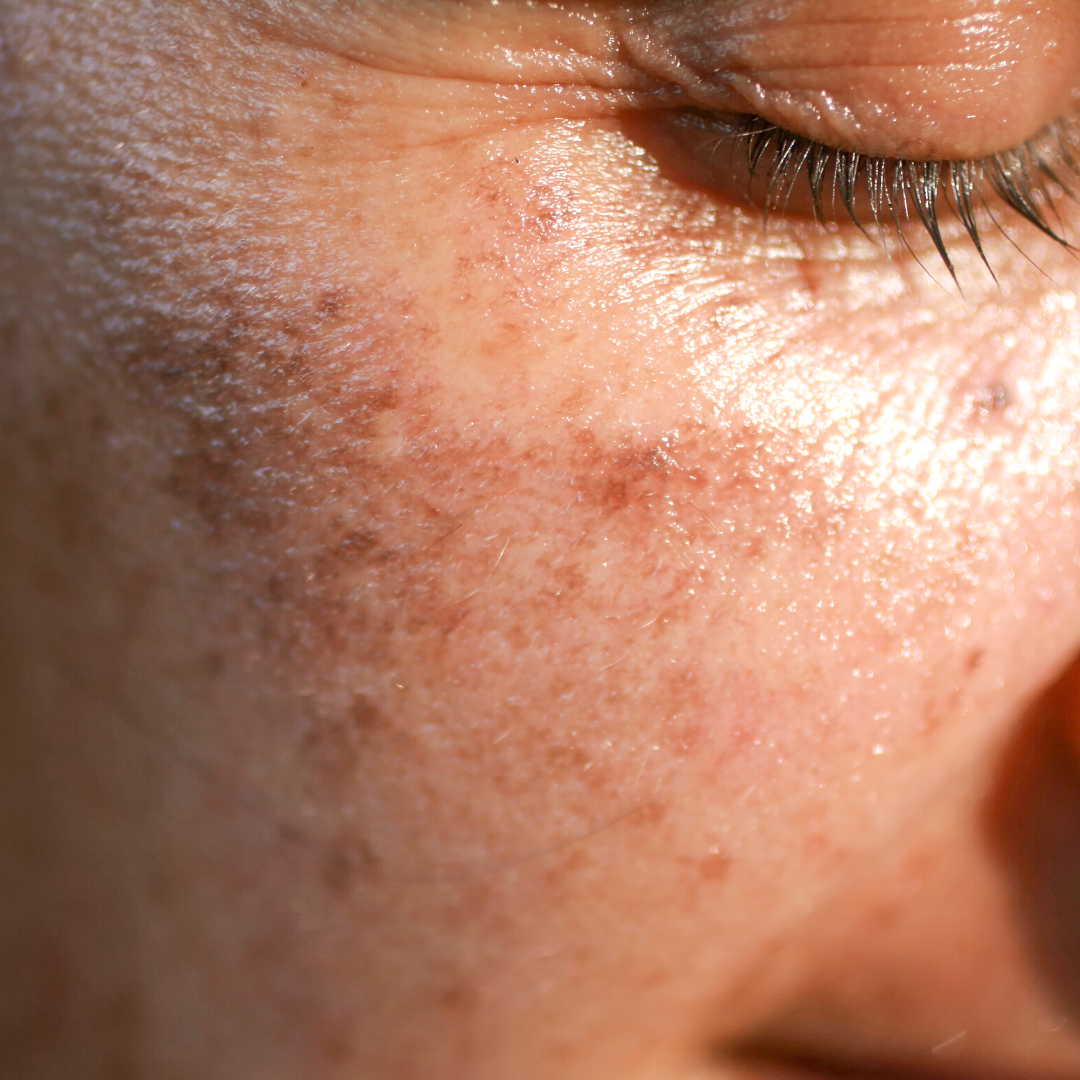 Taches pigmentaires sur le visage : nos solutions